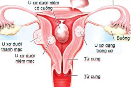 Nhân xơ tử cung có mang thai được không?